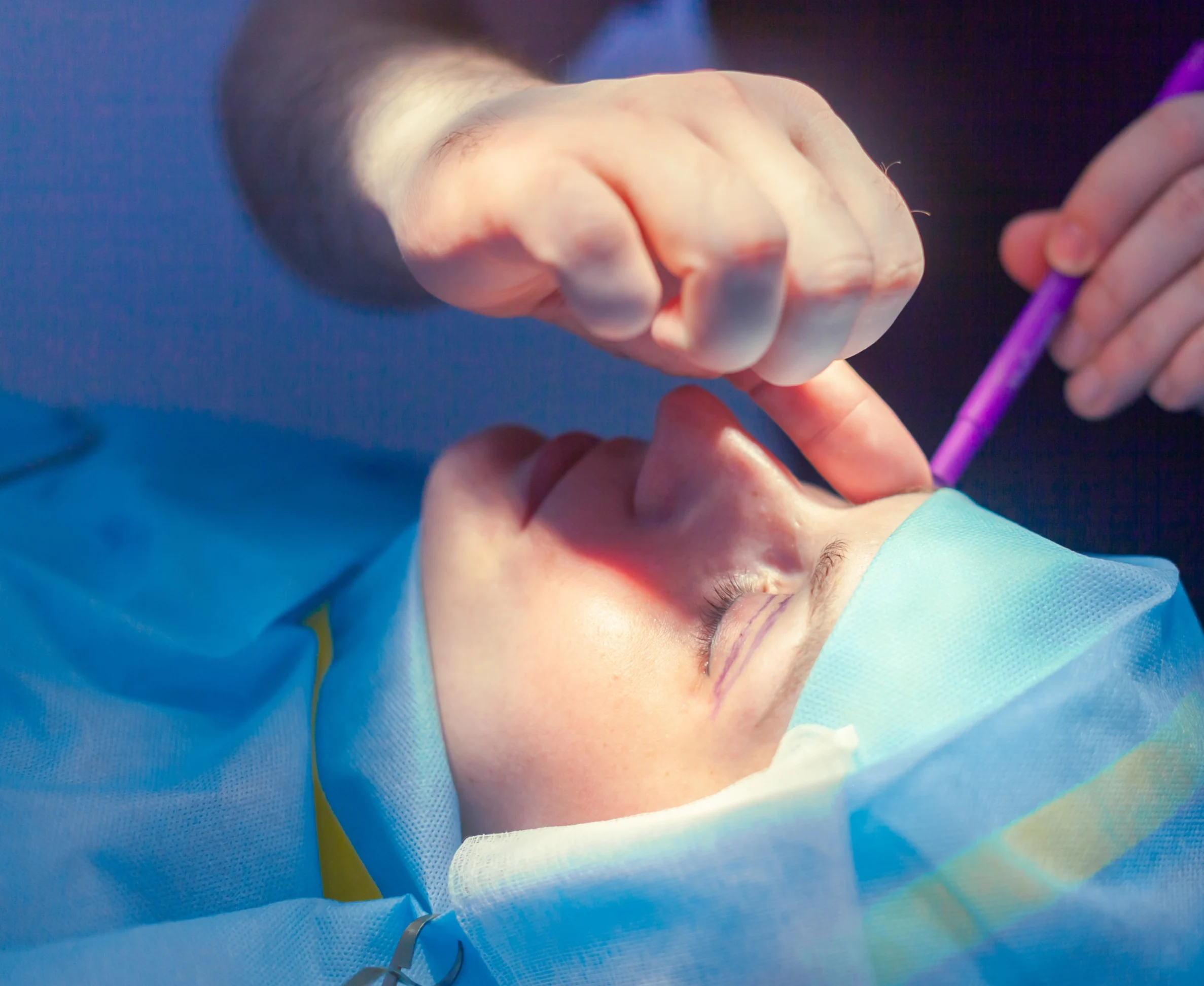blefaroplastia 02
