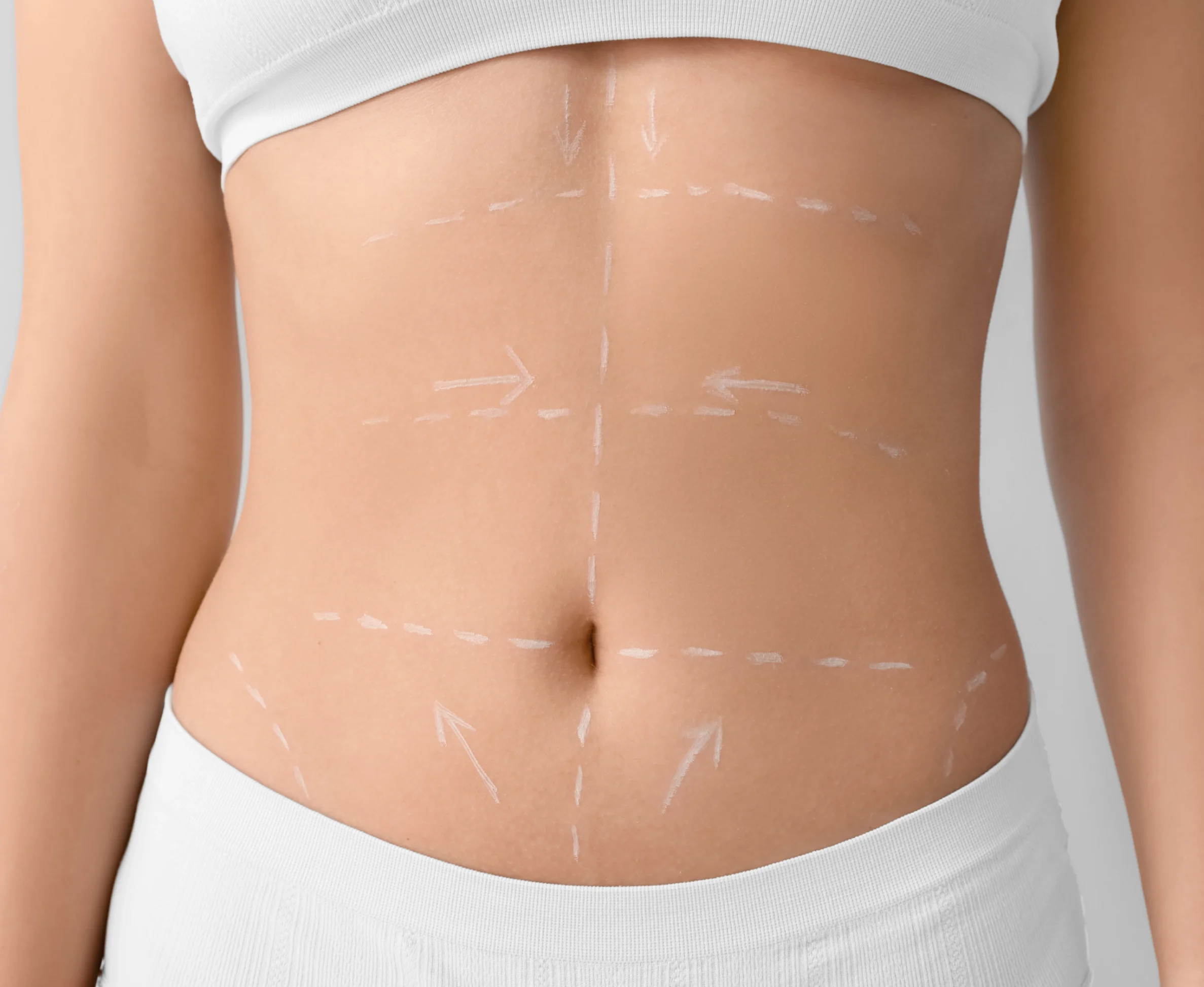 lipoabdominoplastia